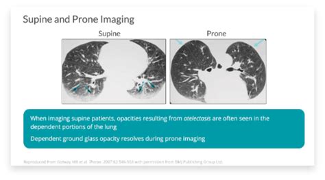 Hrct Vs X Ray For Ild Evaluation Suspect Ild