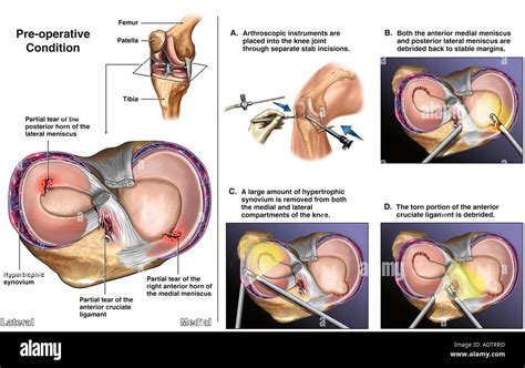 Torn Meniscus Surgery Cost With Insurance - Life Insurance Quotes