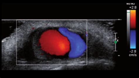 Cellulitis Internet Book Of Msk Ultrasound