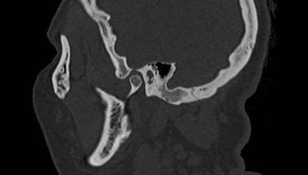 Exostosis Of The External Auditory Canal Surfer S Ear Image