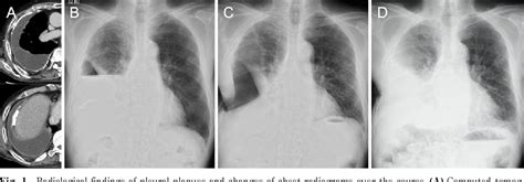 Figure 1 From Successful Closure Of Open Window Thoracostomy Using