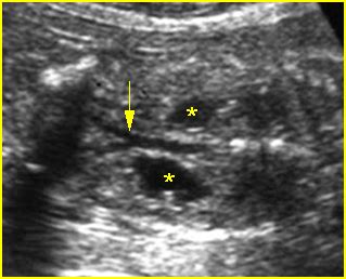 Hydronephrosis Department Of Obstetrics And Gynecology Faculty Of