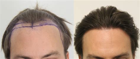 Considering A Fue Hair Transplant In Los Angeles Read This