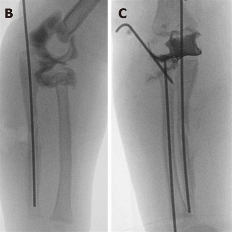 Intraoperative Images A And B Intraoperative Anteroposterior Ap A