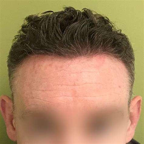 25 Hair Transplant 5 Months Sanketalaiton