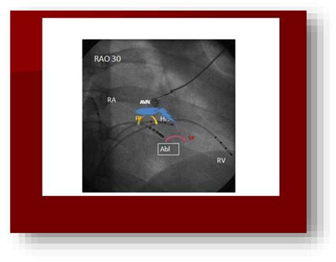 Figure 3 From Catheter Ablation Of Common Atrioventricular Nodal