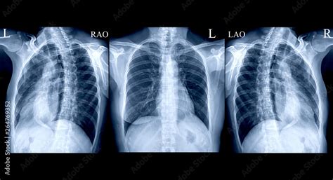 Collection Chest X Ray Or X Ray Image Of Human AP And Both Oblique View