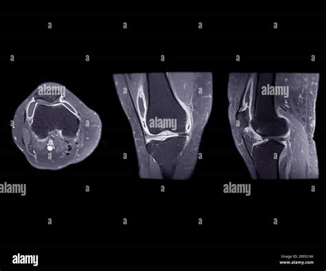 Magnetresonanztomographie Oder MRT Des Kniegelenks Axial Koronal Und