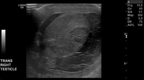 Solution To Unknown Case 7 Focal Orchitis With Pyocele