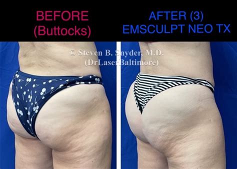 Emsculpt Results | Build Muscle and Shape the Body