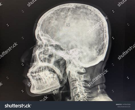 Osteolytic Lesion Skull Lateral View Multiple Stock Photo 1479547028 | Shutterstock