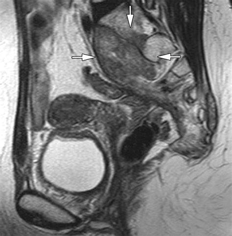 Anatomic And Pathologic Findings At External Phased Array Pelvic Mr Imaging After Surgery For