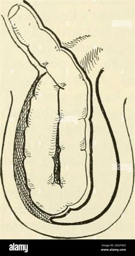 Hernia inguinal femoral Banque de photographies et dimages à haute