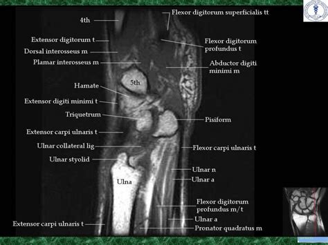 Anatomy and imaging of wrist joint (MRI AND XRAY)