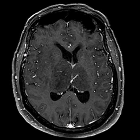 Axial T Weighted Post Contrast Mri The Image Demonstrates