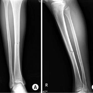 16 Year Old Male Both Knee AP A And Lateral B C Radiograph Of The