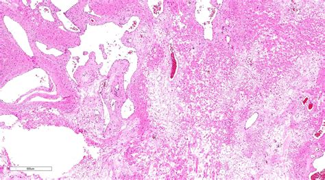 Pathology Outlines Angioleiomyoma