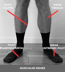 Pronation Distortion Syndrome