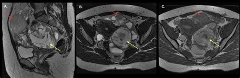 Granulosa Cell Tumor Of The Ovary On A Year Old Women Mri T2 Tse