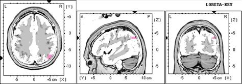 Results Of The T Test On The Individual Loreta Modeling Localization