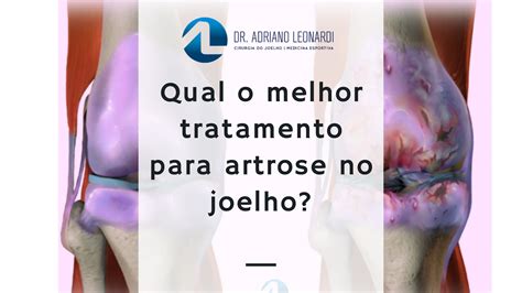 Qual O Melhor Tratamento Para Artrose No Joelho