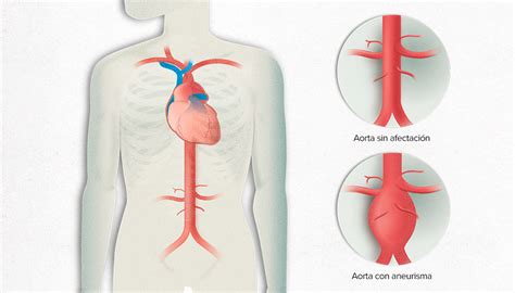 Aneurisma de Aorta Qué es el Aneurisma de Aorta PortalClínic