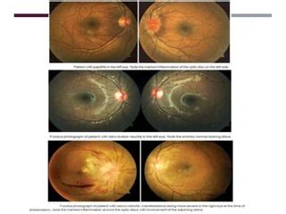 Optic neuritis | PPT