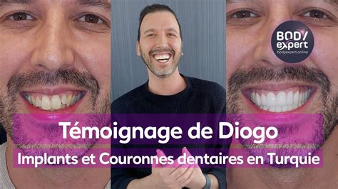 Implants Dentaires En Turquie T Moignage De Diogo Implants