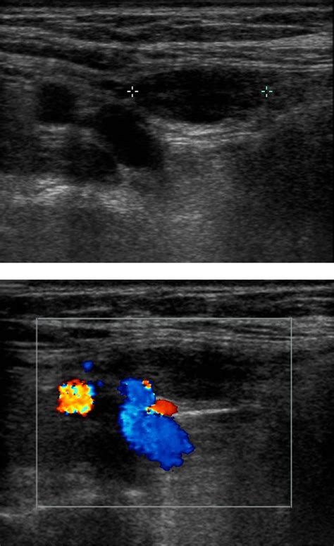 Figure 1 From Hydrocele Of The Canal Of Nuck Ultrasound And Mri