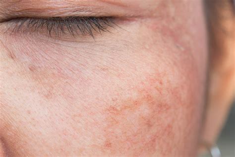 Sun Damage Treatments Skin Md Laser And Cosmetic Group