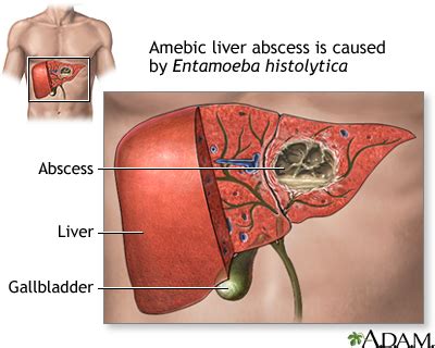 Amebic Liver Abscess Pictures