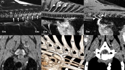 Case 3 A On A Parasagittal T2‐weighted Image Multiple Hypointense