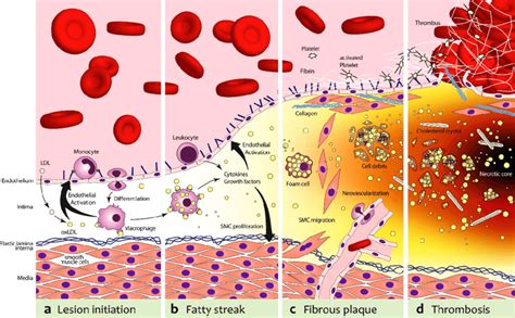 Pathogenesis Of Atherosclerosis A In The First Stage Low Density