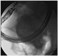 Abbildungen Und Graphiken Interventionelle Therapie Versus Operation