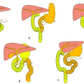 Operative procedures: (a) Roux-en-Y hepaticojejunostomy; (b) status ...