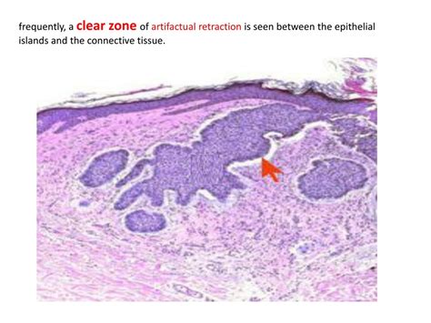 Ppt Basal Cell Carcinoma Rodent Ulcer Powerpoint Presentation