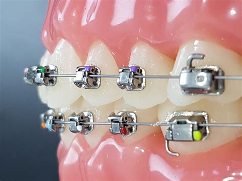 Damon System By Dr Derek Mahony Excellence In Orthodontics And