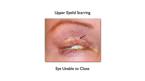 Can Upper Blepharoplasty Go Wrong Dr Prasad Blog