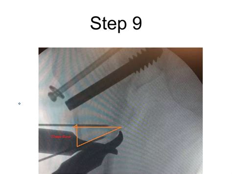 Valgus Or Abduction Osteotomy For Non Union Femur Ppt