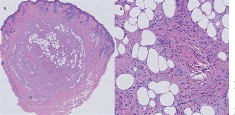 Figure 2 From A Rare Recurrent Spindle Cell Lipoma Of The Nose