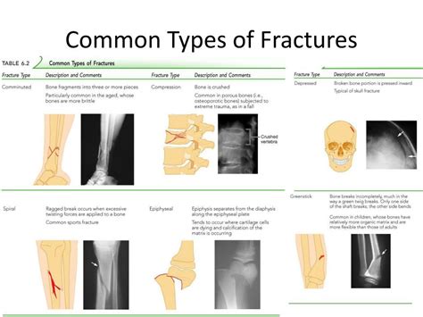 5 Different Types Of Fractures