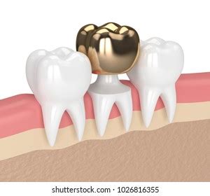 Gold Dental Crown Images Stock Photos Vectors Shutterstock