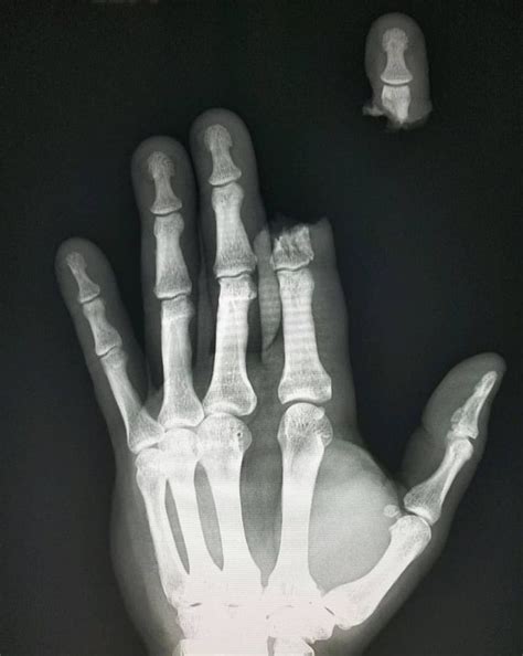 Hand X Ray Showing Complete Second Finger Amputation After MEDizzy