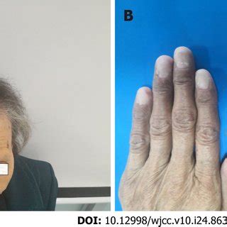 Signs in the patient with Cronkhite-Canada syndrome. A: The patient had... | Download Scientific ...