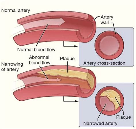 Peripheral Arterial Disease Plaque Manhattan Cardiology