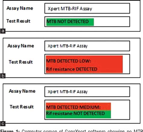 Genexpert Mtb Rif Assay A Major Milestone For Diagnosing