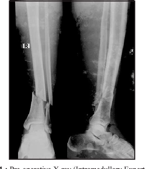 Figure From Extra Articular Proximal And Distal Metaphyseal Tibial