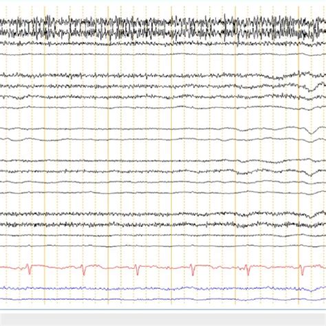 Electroencephalogram Eeg Showing Diffuse Encephalopathy Download