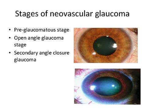 Secondary Glaucoma Dr Ajai Agrawal Additional Professor Department