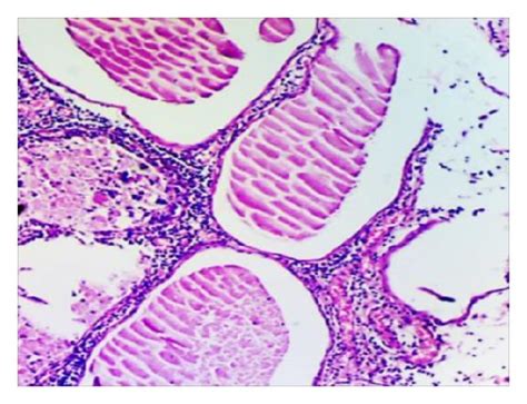 Histological Views Of Prostatic Inflammation In All Groups Normal